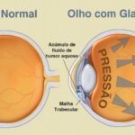 glaucoma