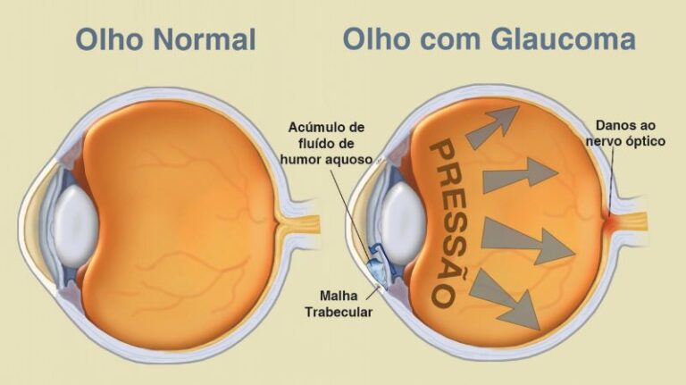 glaucoma