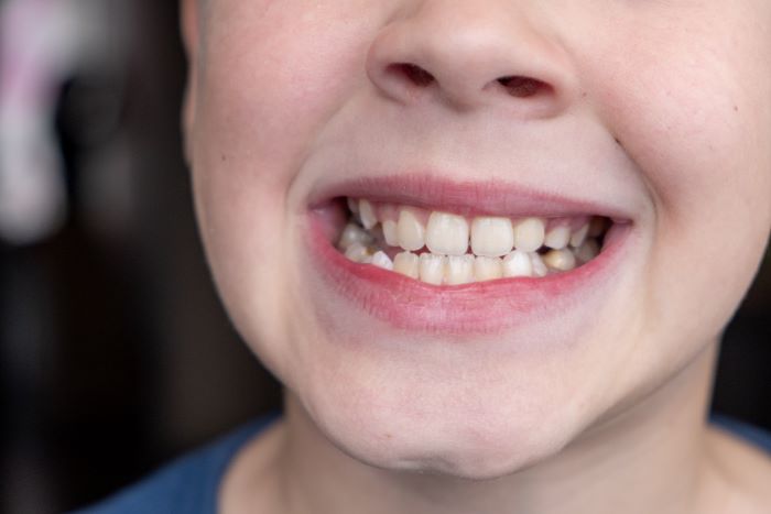 child-s-crooked-teeth-young-man-showing-crooked-g-2023-11-27-05-19-20-utc