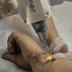 Despigmentacao-a-laser-LypeDepyl-credito-divulgacao