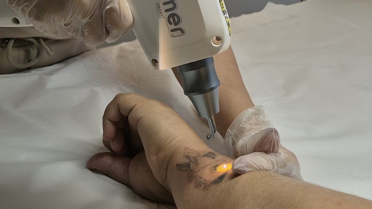 Despigmentacao-a-laser-LypeDepyl-credito-divulgacao